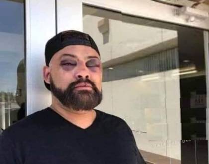 De ce un bărbat are ochiul v&acirc;năt